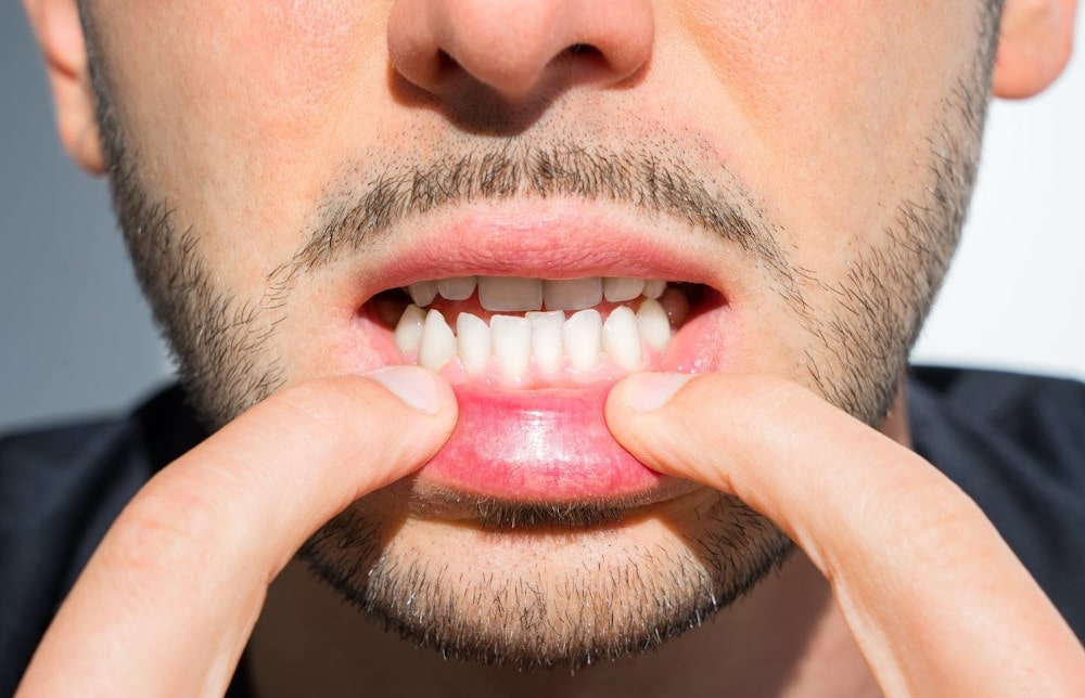 Right Type of Braces