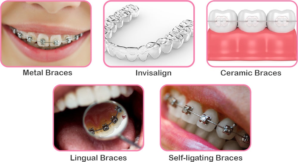 Types of Braces
